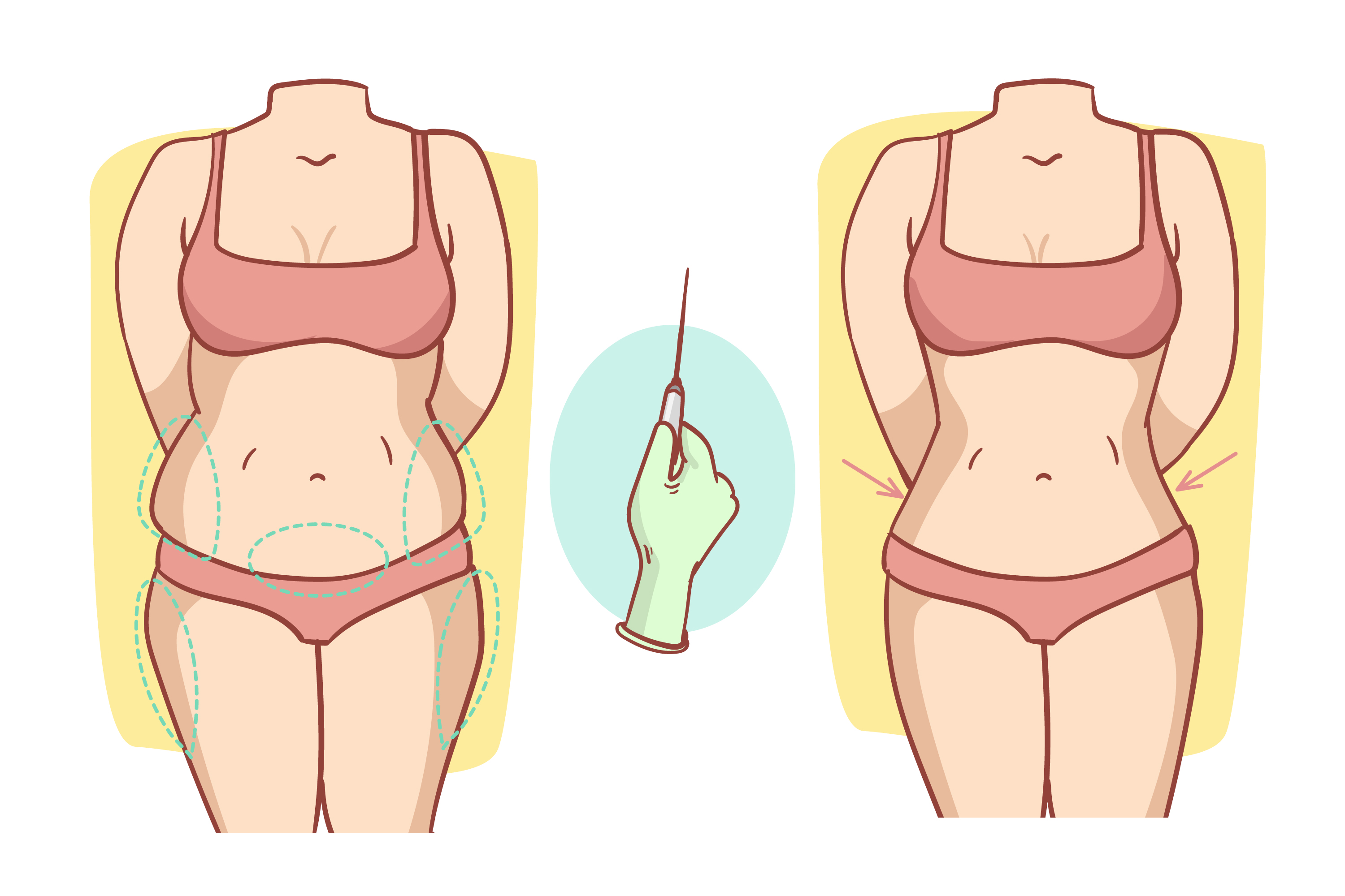 5 Reasons Behind the Ubiquitous Popularity of Tummy Tuck Surgery